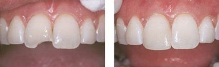 Side-by-side before and after photos showing how a tooth chip can be seamlessly restored with dental bonding by a skilled cosmetic dentist.