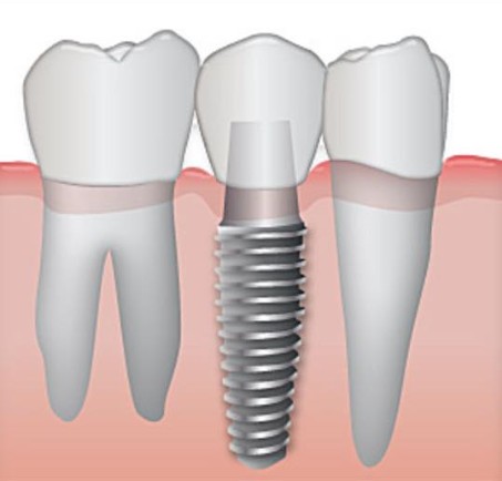 Digital drawing of a dental implant that shows a crown attached to the abutment and embedded fixture, situated between two natural teeth.