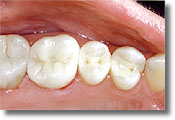 Photo of three teeth restored at the dentist with mercury-free white composite fillings.