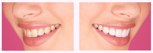 Side-by-side before and after photos showing the dramatic change that teeth whitening by a cosmetic dentist can bring to a smile.