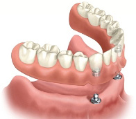 Digital drawing of a lower arch of implant-supported dentures.
