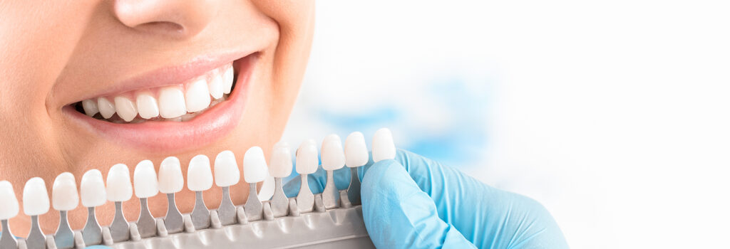 A woman's teeth are color-matched to create her ideal smile with porcelain veneers.