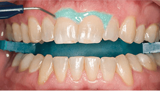 Photo of a patient's gums being covered with a protective coating during an Opalescence Pro teeth whitening session.