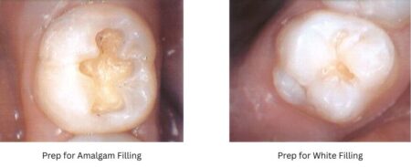 Side-by-side photos show the difference in the amount of tooth structure removal required for the placement of white fillings compared with that for amalgams.