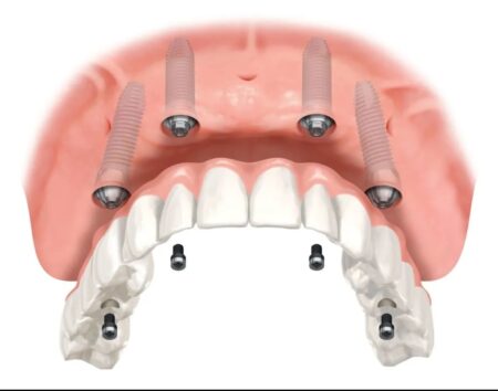 Rendering of a fixed implant denture, one of the types of implant-supported dentures we offer.