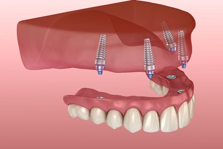 Rendering of an upper arch of fixed implant-supported dentures.