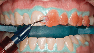 Photo of a patient's teeth being treated with peroxide gel during an Opalescence Pro whitening session.