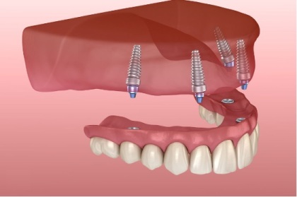Upper denture supported by implants