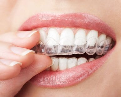 teeth bleaching trays being placed