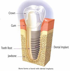 Dental implant in bone